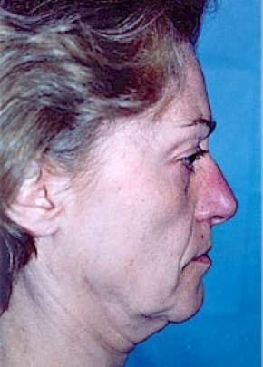 Facelift And Mini Facelift Before & After Photos | Associates in Plastic Surgery