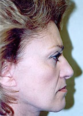 Facelift And Mini Facelift Before & After Photos | Associates in Plastic Surgery