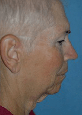 Facelift And Mini Facelift Before & After Photos | Associates in Plastic Surgery