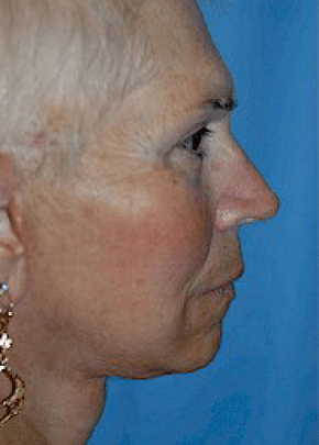 Facelift And Mini Facelift Before & After Photos | Associates in Plastic Surgery
