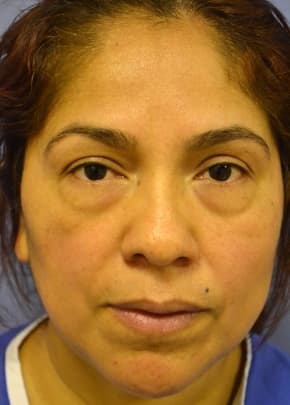 Fat Injection Before & After Photos | Associates in Plastic Surgery