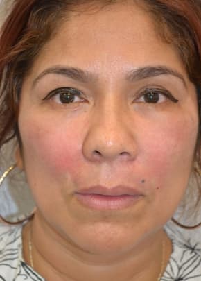 Fat Injection Before & After Photos | Associates in Plastic Surgery