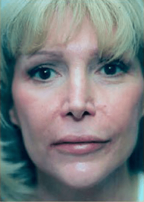 Fat Injection Before & After Photos | Associates in Plastic Surgery