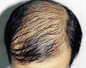 Hair Transplant Before & After Photos | Associates in Plastic Surgery