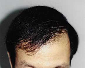 Hair Transplant Before & After Photos | Associates in Plastic Surgery