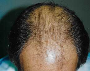 Hair Transplant Before & After Photos | Associates in Plastic Surgery
