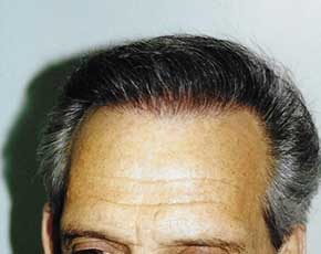 Hair Transplant Before & After Photos | Associates in Plastic Surgery