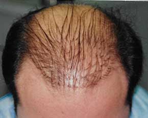Hair Transplant Before & After Photos | Associates in Plastic Surgery