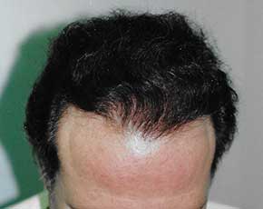 Hair Transplant Before & After Photos | Associates in Plastic Surgery