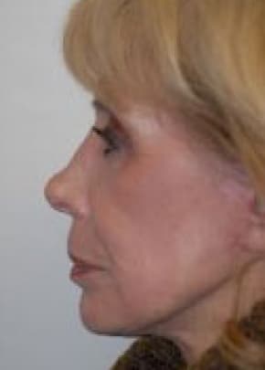 Laser Wrinkle Removal Before & After Photos | Associates in Plastic Surgery