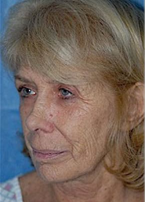 Laser Wrinkle Removal Before & After Photos | Associates in Plastic Surgery