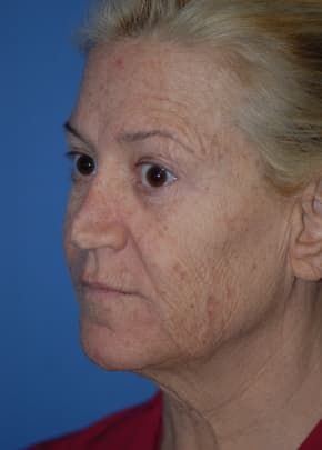 Laser Wrinkle Removal Before & After Photos | Associates in Plastic Surgery