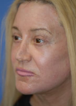 Laser Wrinkle Removal Before & After Photos | Associates in Plastic Surgery