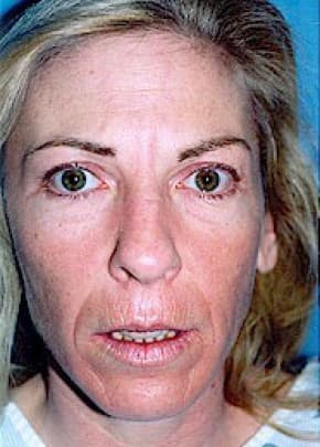 Laser Wrinkle Removal Before & After Photos | Associates in Plastic Surgery