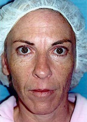 Laser Wrinkle Removal Before & After Photos | Associates in Plastic Surgery