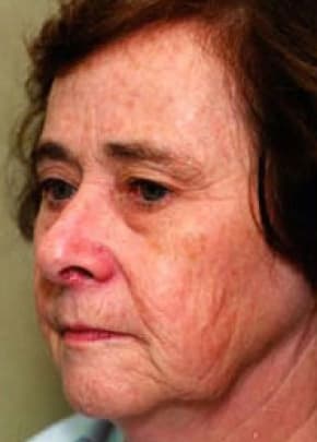 Laser Wrinkle Removal Before & After Photos | Associates in Plastic Surgery