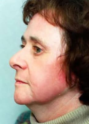 Laser Wrinkle Removal Before & After Photos | Associates in Plastic Surgery