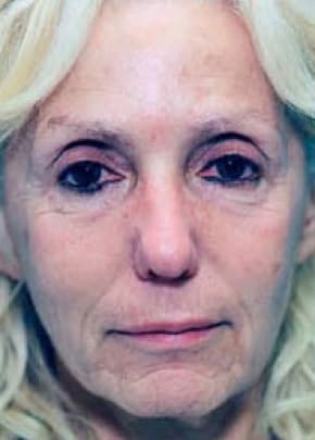 Laser Wrinkle Removal Before & After Photos | Associates in Plastic Surgery