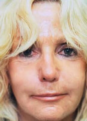 Laser Wrinkle Removal Before & After Photos | Associates in Plastic Surgery