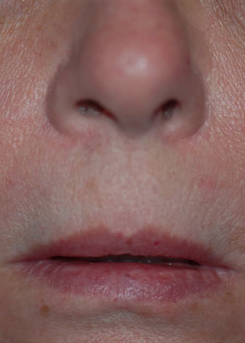 Lip Enhancement Before & After Photos | Associates in Plastic Surgery