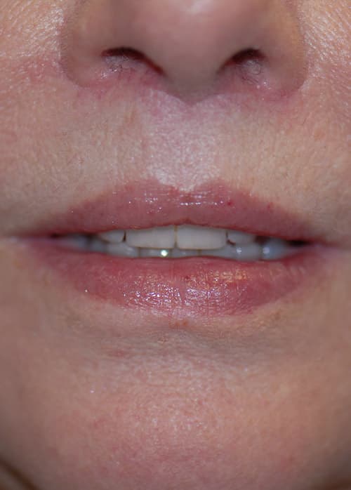 Lip Enhancement Before & After Photos | Associates in Plastic Surgery