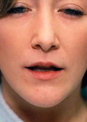 Lip Enhancement Before & After Photos | Associates in Plastic Surgery