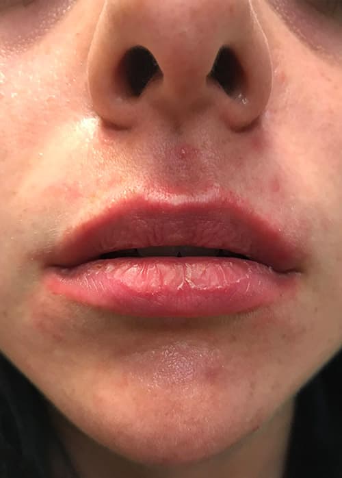 Lip Enhancement Before & After Photos | Associates in Plastic Surgery