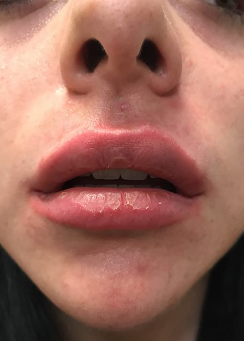 Lip Enhancement Before & After Photos | Associates in Plastic Surgery