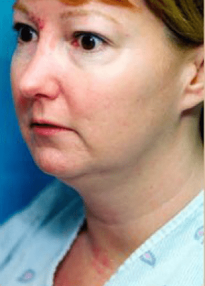 Necklift And Necklipo Before & After Photos | Associates in Plastic Surgery