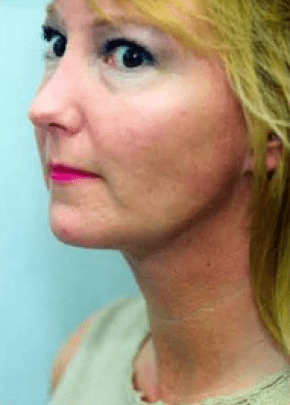 Necklift And Necklipo Before & After Photos | Associates in Plastic Surgery