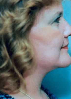 Necklift And Necklipo Before & After Photos | Associates in Plastic Surgery