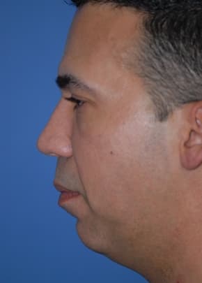 Necklift And Necklipo Before & After Photos | Associates in Plastic Surgery