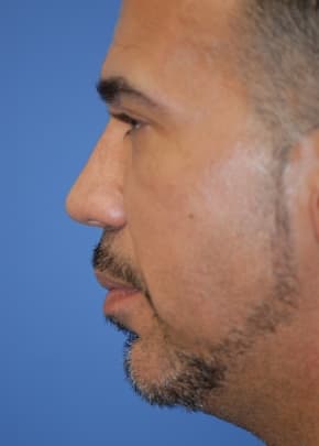 Necklift And Necklipo Before & After Photos | Associates in Plastic Surgery