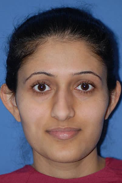 Otoplasty Before & After Photos | Associates in Plastic Surgery