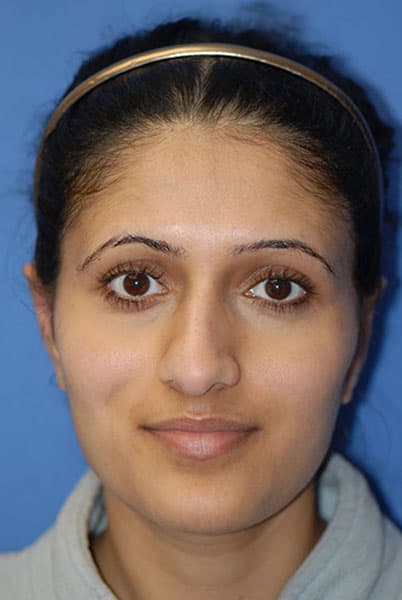 Otoplasty Before & After Photos | Associates in Plastic Surgery