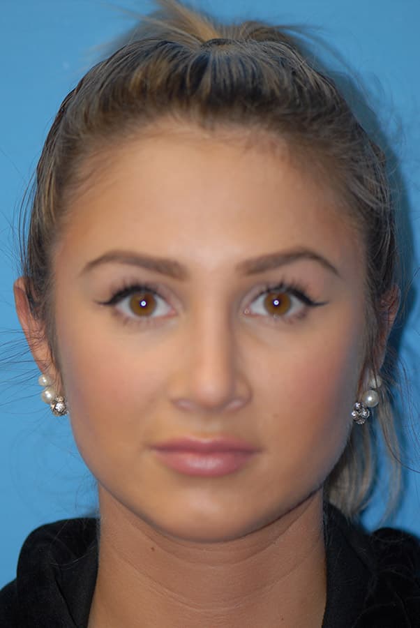 Otoplasty Before & After Photos | Associates in Plastic Surgery