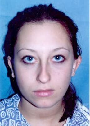 Otoplasty Before & After Photos | Associates in Plastic Surgery
