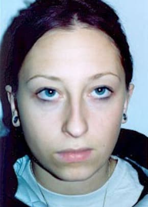 Otoplasty Before & After Photos | Associates in Plastic Surgery