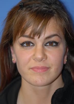 Otoplasty Before & After Photos | Associates in Plastic Surgery
