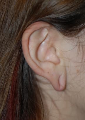 Otoplasty Before & After Photos | Associates in Plastic Surgery