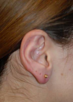 Otoplasty Before & After Photos | Associates in Plastic Surgery
