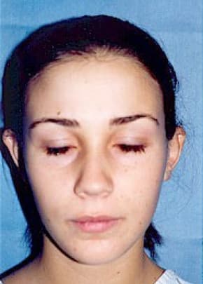 Otoplasty Before & After Photos | Associates in Plastic Surgery