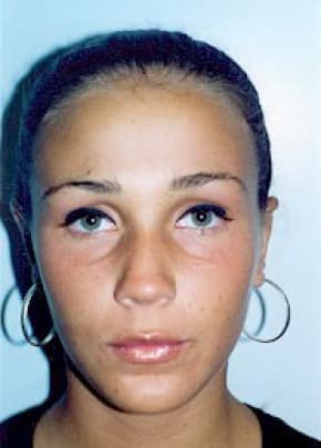 Otoplasty Before & After Photos | Associates in Plastic Surgery