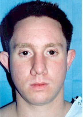 Otoplasty Before & After Photos | Associates in Plastic Surgery