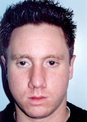 Otoplasty Before & After Photos | Associates in Plastic Surgery